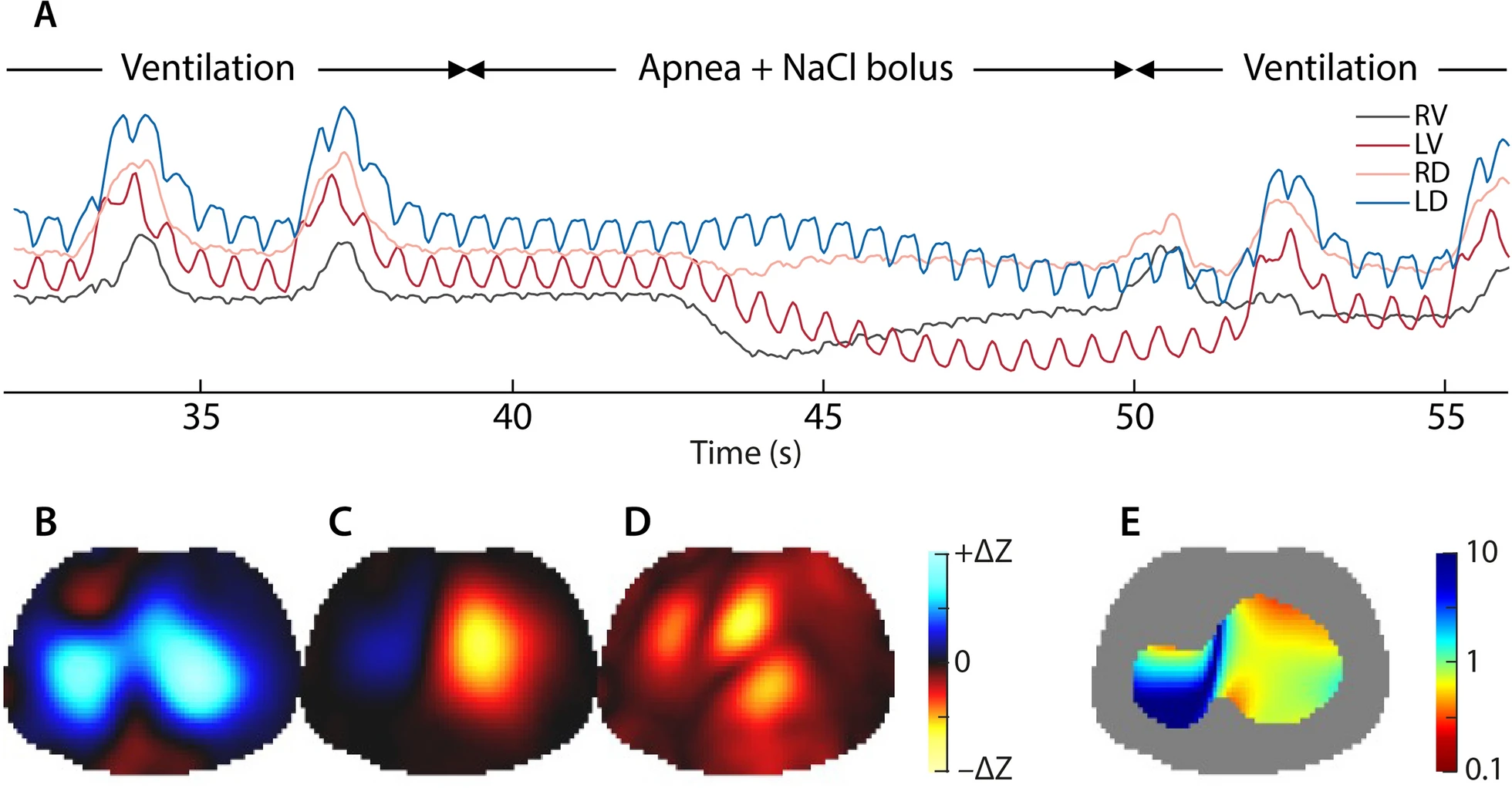 Electrical Impedance Tomography Monitoring in ICU